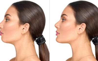 The Power Couple: Lip Filler + Chin Filler