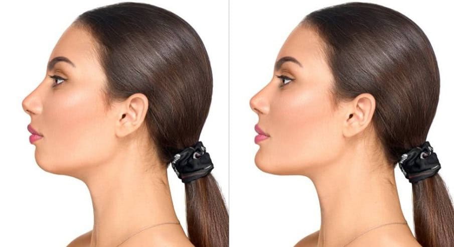 The Power Couple: Lip Filler + Chin Filler